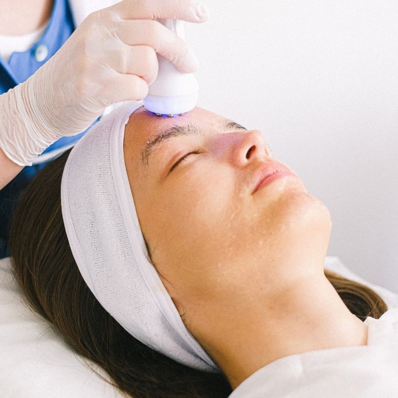 laser treatments for acne