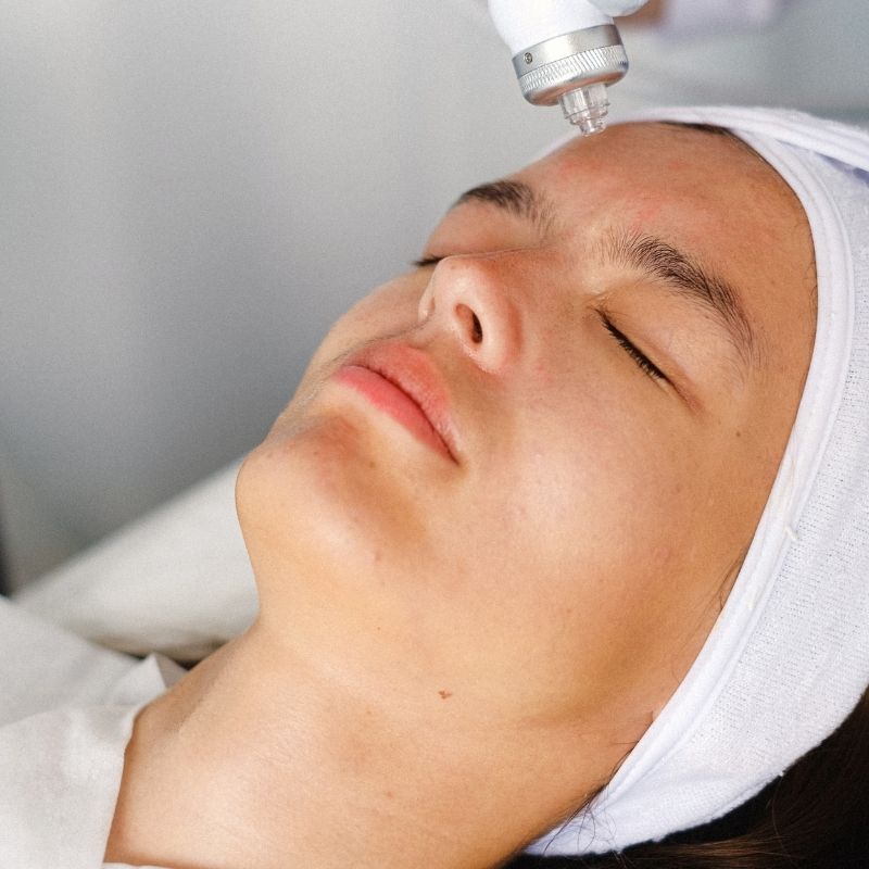 microneedling for acne